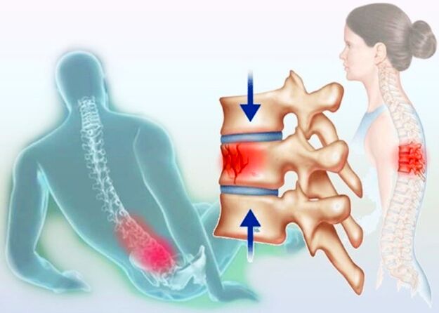 Incluso una lesión normal puede provocar el desarrollo de osteocondrosis.