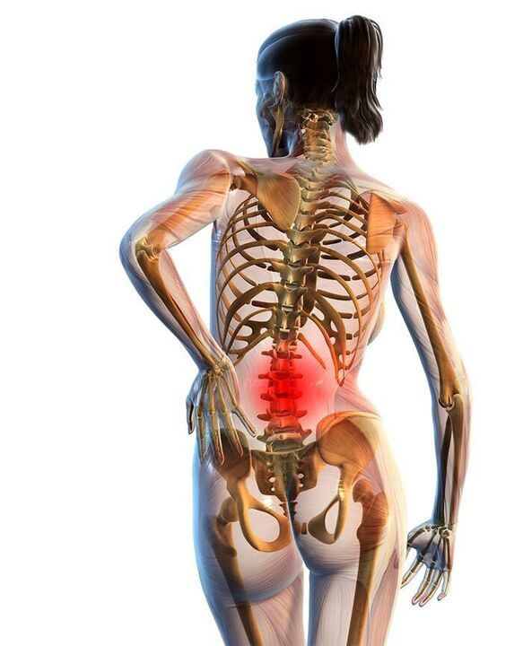 La osteocondrosis de la columna lumbar ocurre con mayor frecuencia.