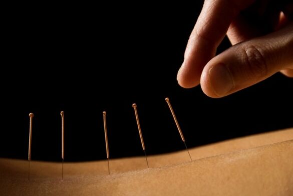 La acupuntura ayudará a eliminar el dolor lumbar