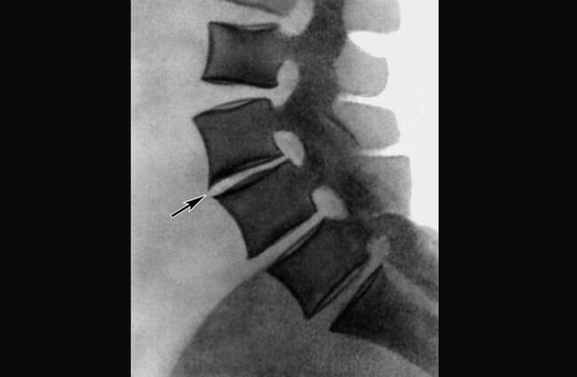 Manifestaciones de osteocondrosis de la columna torácica en una radiografía.